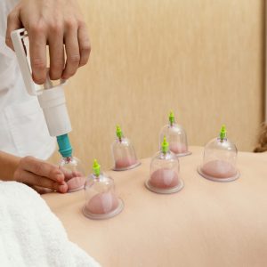 close-up-cupping-therapy-experience
